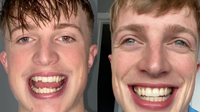 Sean Fitz - 6 month braces - 3Dental